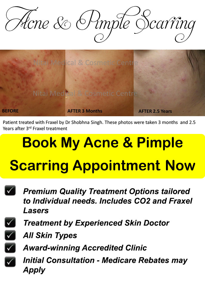 Make and Appointment for Acne and Pimple Scarring Treatment