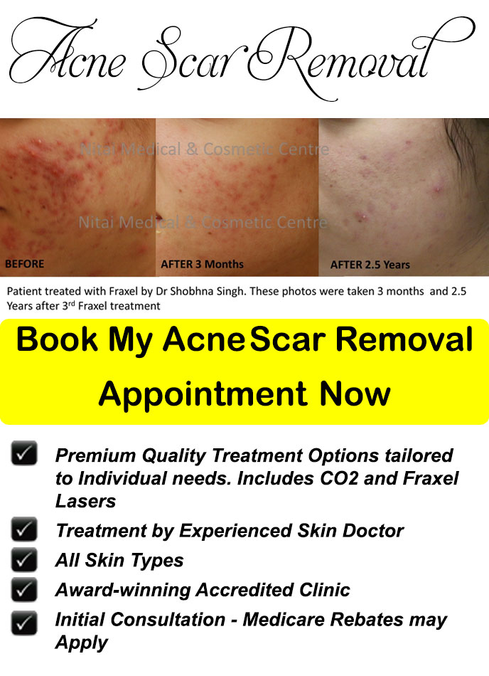 Acne Scar Removal