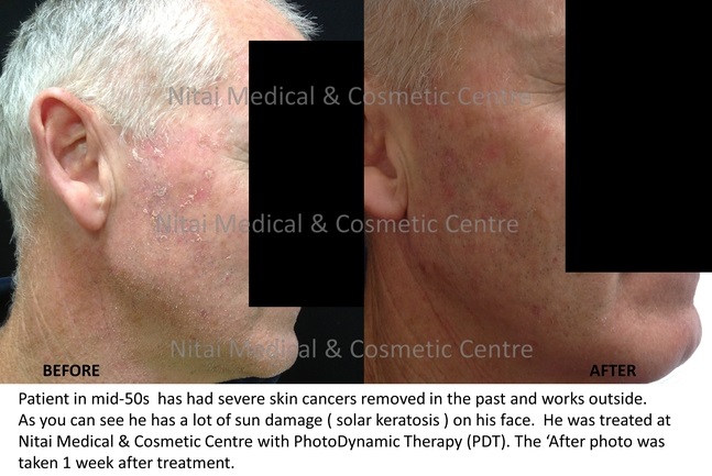 Acne Treatment - Photodynamic Therapy